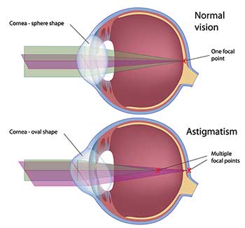 astigmatism