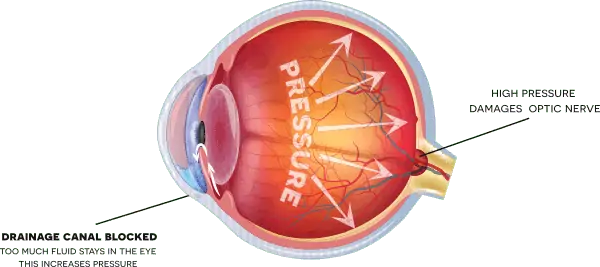 Diagram of an eye with a blocked drainage canal and high pressure damaging the optic nerve