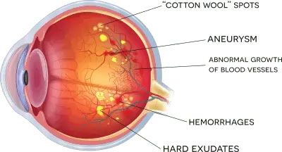 Diagram of diabetic retinopathy affecting retinal blood vessels