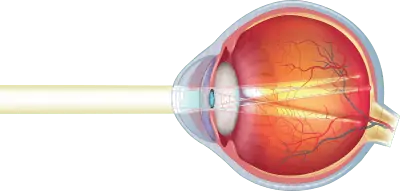 The curvature of the cornea (lens of the eye) is uneven, causing the object to appear blurry or wavy on the retina.