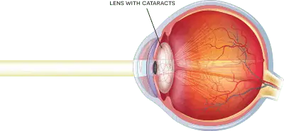 Diagram of an eye with a cataract clouding the natural lens