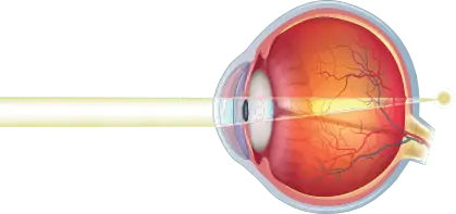 The eye is shorter, causing the focus point to occur behind the retina, and the nearby object to appear blurry.
