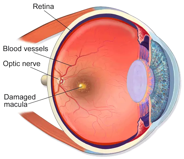 Damage to the macula prevents light from reaching the optic nerve, creating a blurry area right in the center of the field of vision.