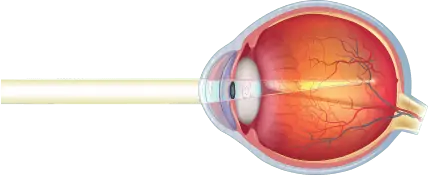 The eye is longer, causing the focus point to occur before the retina, and the far-away object to appear blurry.