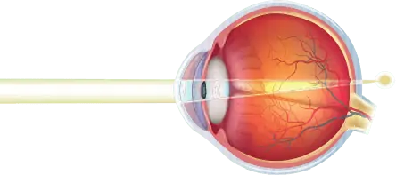 The lens becomes less flexible with age, making it difficult to focus on close objects